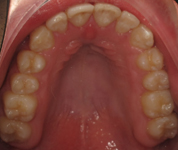 Patient1-after-middle1