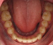 Patient1-after-middle3