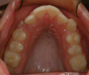 Patient1-before-middle1