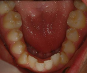 Patient1-before-middle3