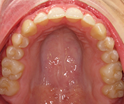 Patient13d-after-middle1