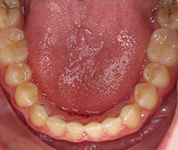 Patient13d-after-middle3