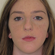 Patient13d-after-top1