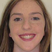 Patient13d-after-top2