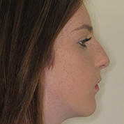 Patient13d-after-top3