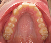 Patient13d-before-middle1