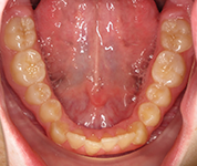 Patient13d-before-middle3