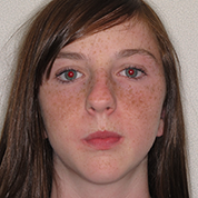 Patient13d-before-top1