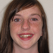 Patient13d-before-top2