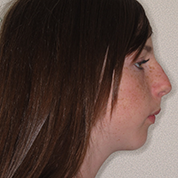 Patient13d-before-top3