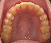 Patient14d-after-middle1