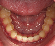 Patient14d-after-middle3