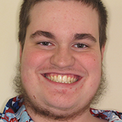 Patient14d-after-top2