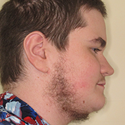 Patient14d-after-top3