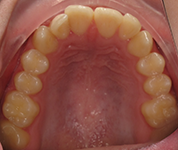 Patient14d-before-middle1