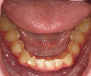 Patient14d-before-middle3