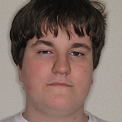 Patient14d-before-top1