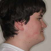 Patient14d-before-top3