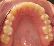 Patient2-after-middle1