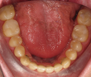 Patient2-after-middle3