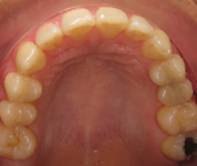 Patient4-after-middle1