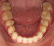 Patient4-after-middle3