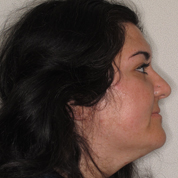 Patient4-before-top3