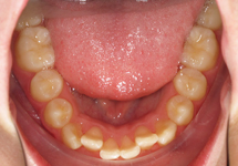 arch-before-11b1