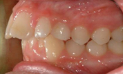 gallery-patient-12c-before-right