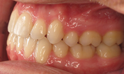 gallery-patient-13c-after-right