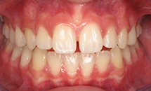 gallery-patient-25a-before