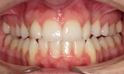 gallery-patient-29c-before-center