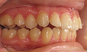 gallery-patient-41c-before-left