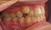 gallery-patient-45c-before-left