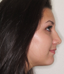 gallery-profile-before-03