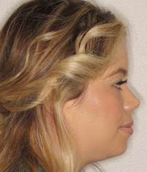 gallery-profile-before-04